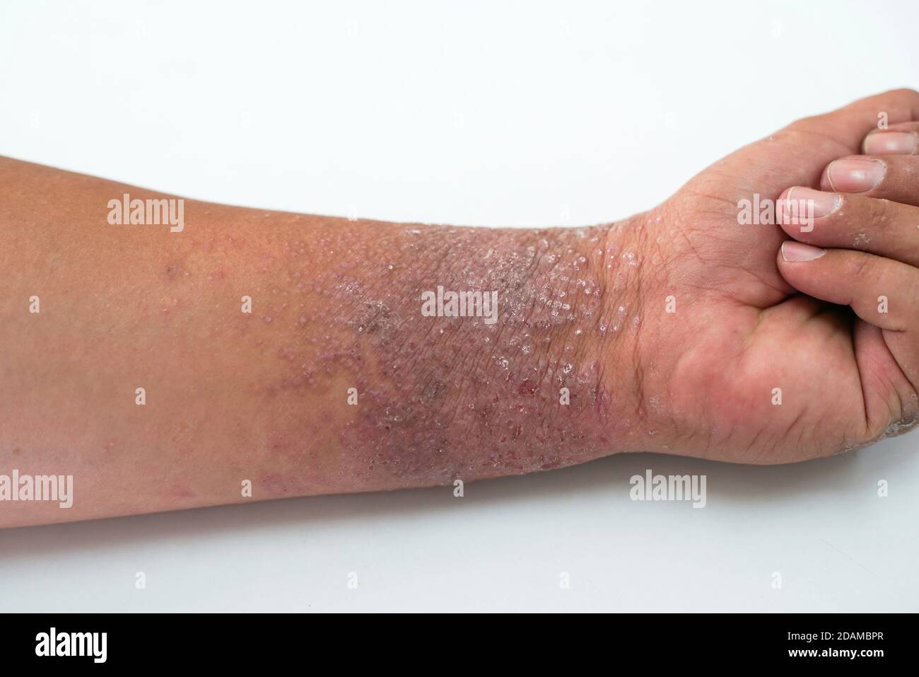 Eczema on a man's wrist. Eczema is an inflammation of the skin that