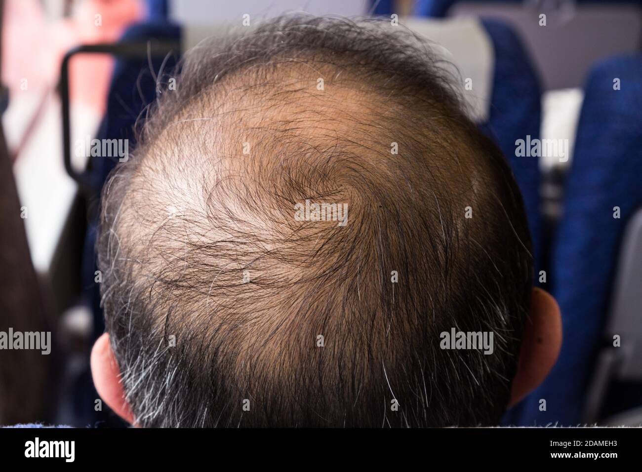 Close-up of balding and thinning hair of man revealing scalp Stock Photo