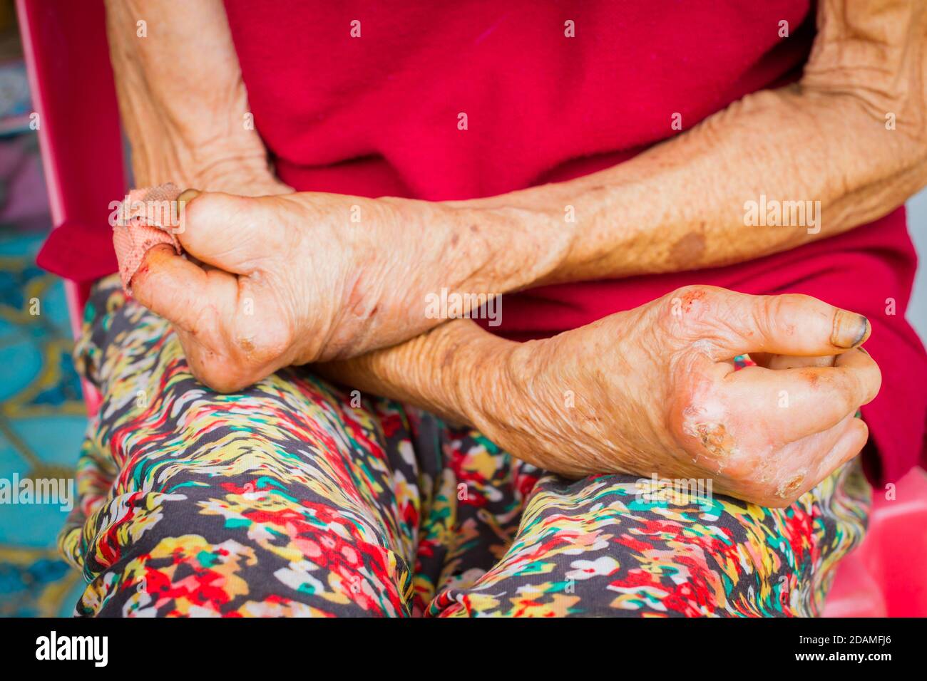 closeup hands of old woman suffering from leprosy, amputated hands Stock Photo