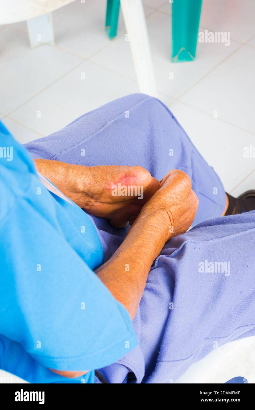 closeup amputated hands of old man suffering from leprosy. Stock Photo