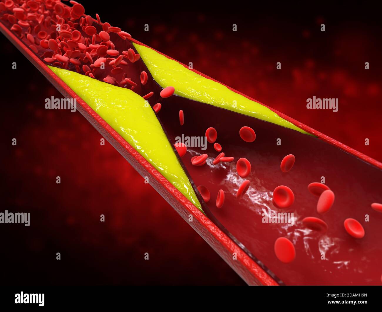 3d rendering atherosclerosis with cholesterol blood or plaque in vessel cause of coronary artery disease Stock Photo