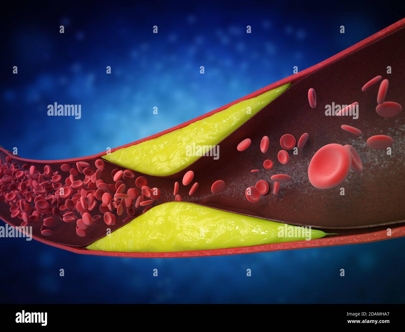 3d rendering atherosclerosis with cholesterol blood or plaque in vessel