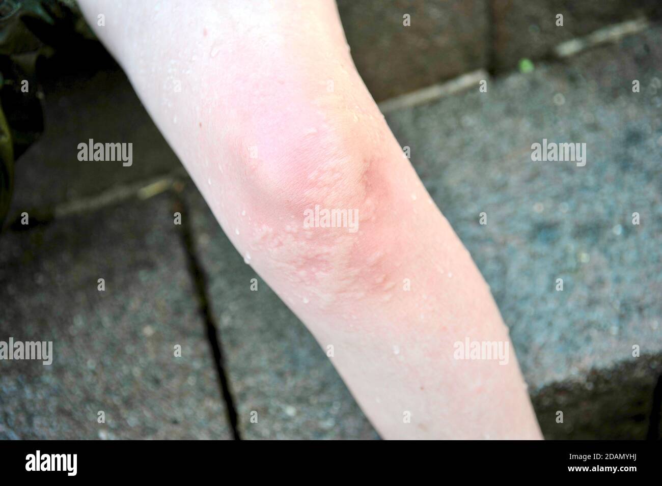 Nettle sting on young boys knee Stock Photo