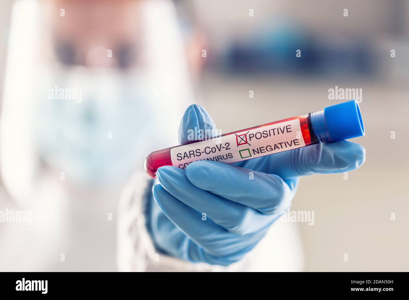 Ampule with a SARS-CoV2 coronavirus positive test in a hand of a medical worker. Stock Photo