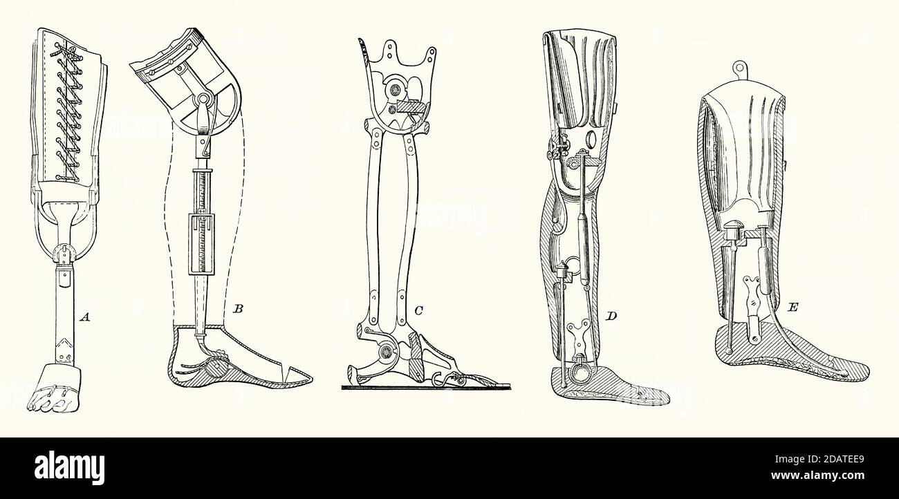 An old engraving of the various prosthetic legs used in the 1800s. It is from a Victorian mechanical engineering book of the 1880s. Londoner James Potts invented an above-knee prosthetic in 1800 with a calf and thigh socket made of wood, and a flexible foot. Illustrations show the differently designed prosthetics used to aid walking. D and E illustrate prosthetics with a ball socket at the ankle joint allowing for added mobility. Stock Photo