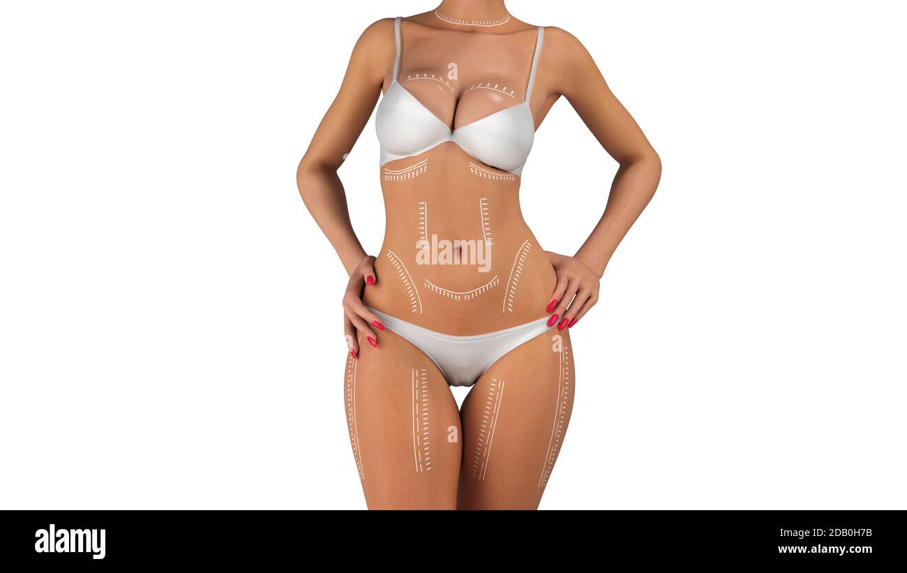 naked brace plastic surgery concept naked girl with braces on the skin 3d render on  white no shadow Stock Photo - Alamy