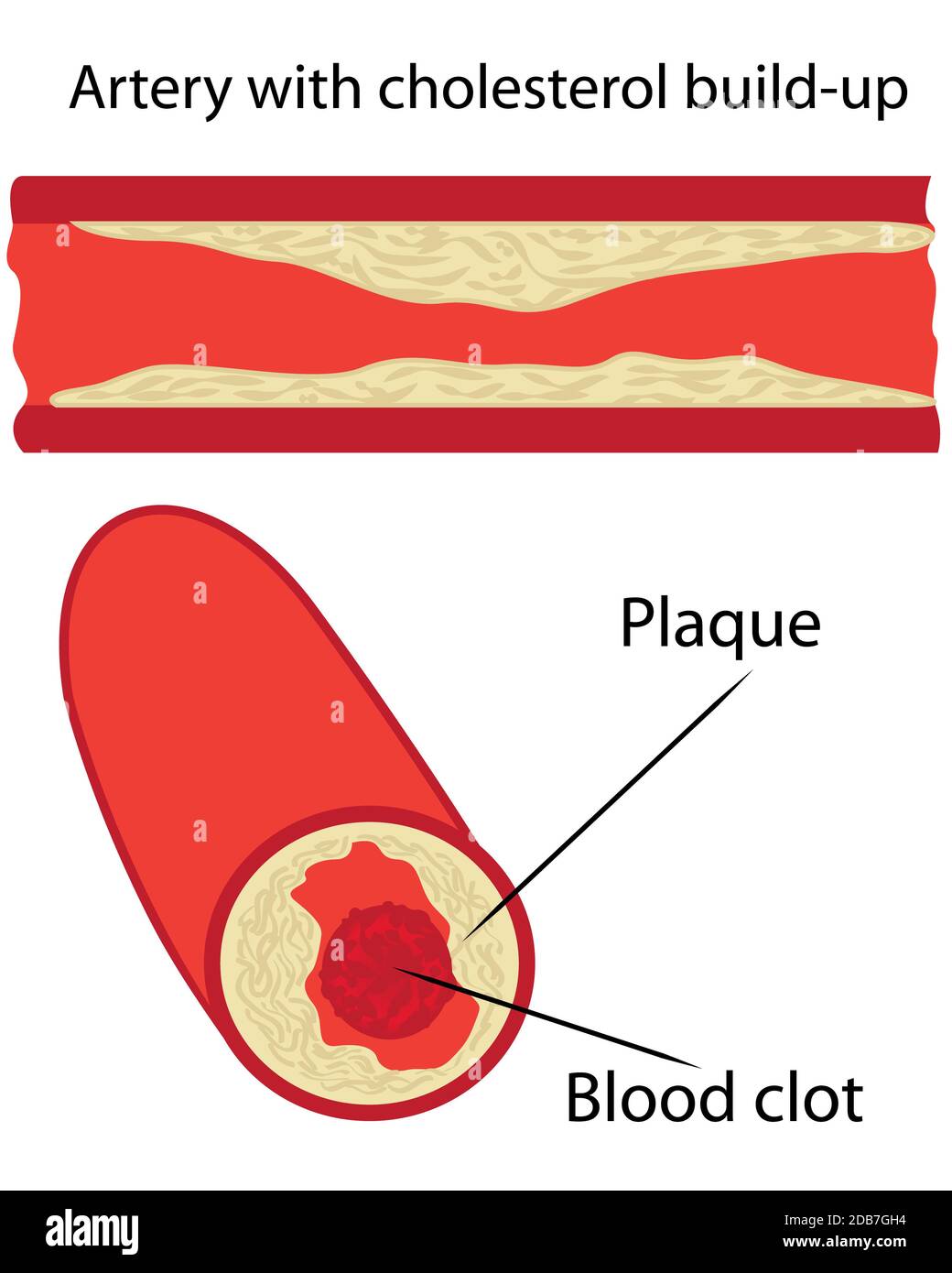 Levels of cholesterol plaque in vessels vector illustration Stock Photo