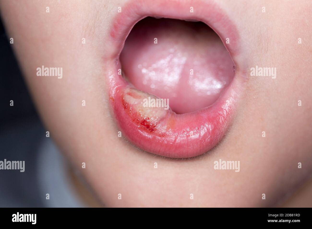 sick boy with big haze on his lips, close photo shot Stock Photo