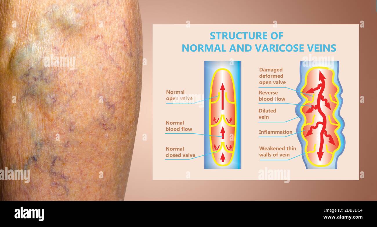 Varicose veins on a female senior legs. Structure of normal and ...
