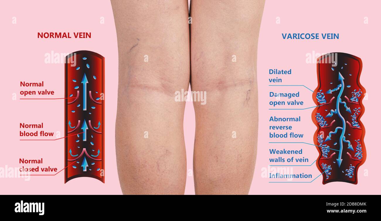 Varicose vein on a female senior legs. The structure of normal and varicose veins. Concept of