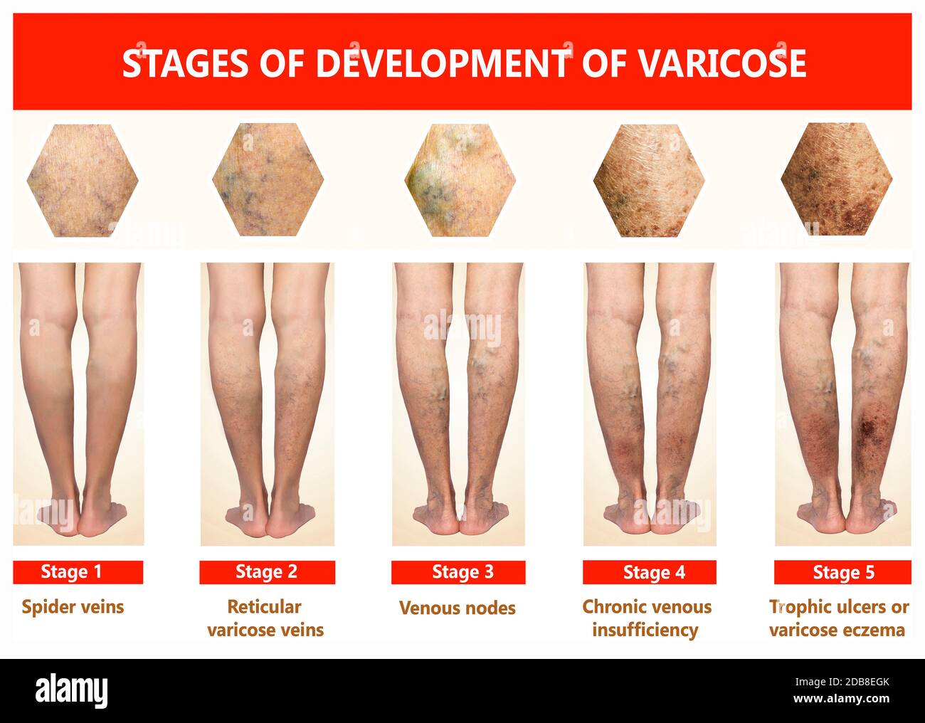 Varicose veins on a female senior legs. The stages of varicose veins. The  old age and
