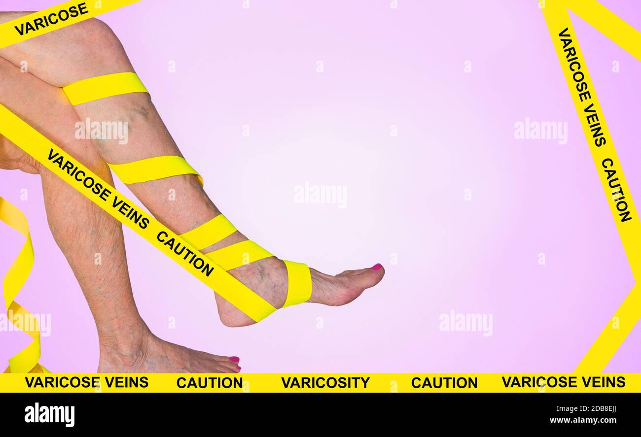 The varicose veins on a legs of old woman white Stock Photo