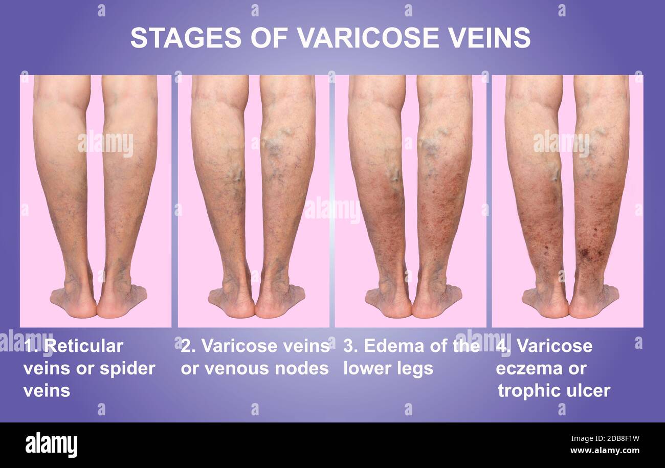 Varicose veins on a female senior legs. The stages of varicose veins Stock Photo