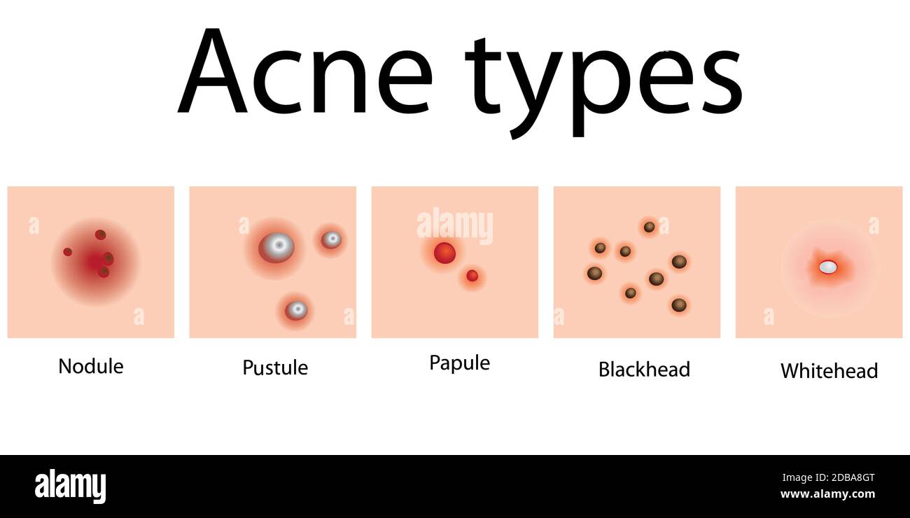 Acne types of problem skin dermatology vector illustration Stock Photo ...