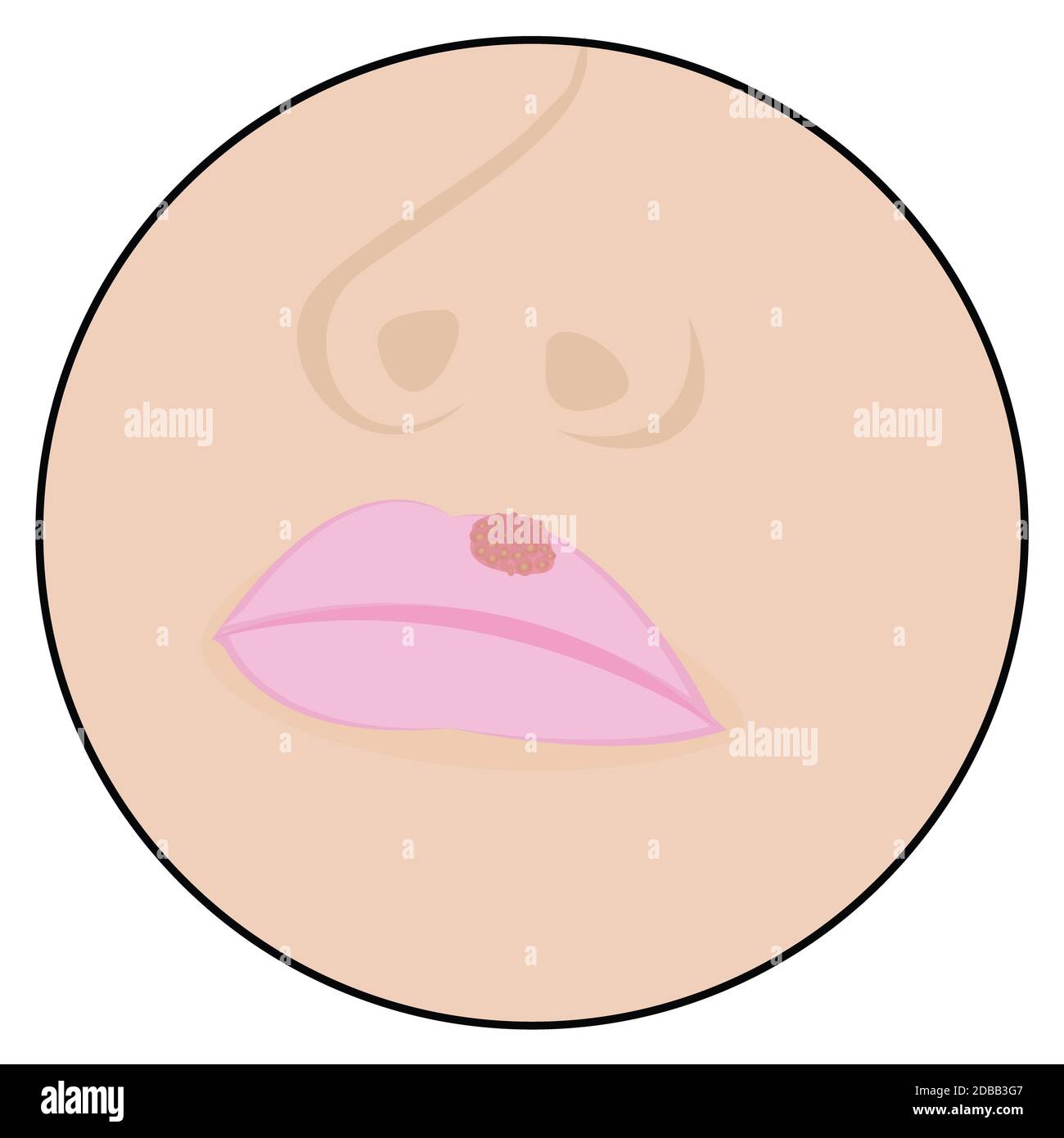 Herpes on lips cold sores viral infection vector illustration Stock ...