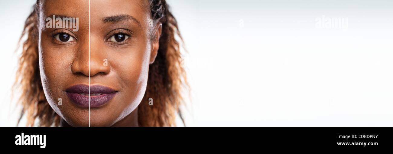 Before And After Black Woman Face Laser Microdermabrasion Stock Photo