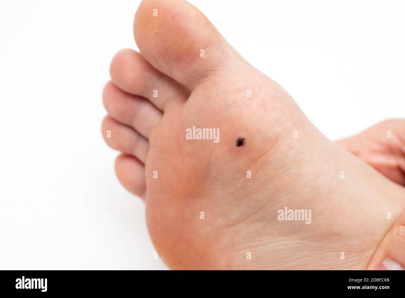Wart on the sole of the foot. Removal of a plantar wart. Stock Photo