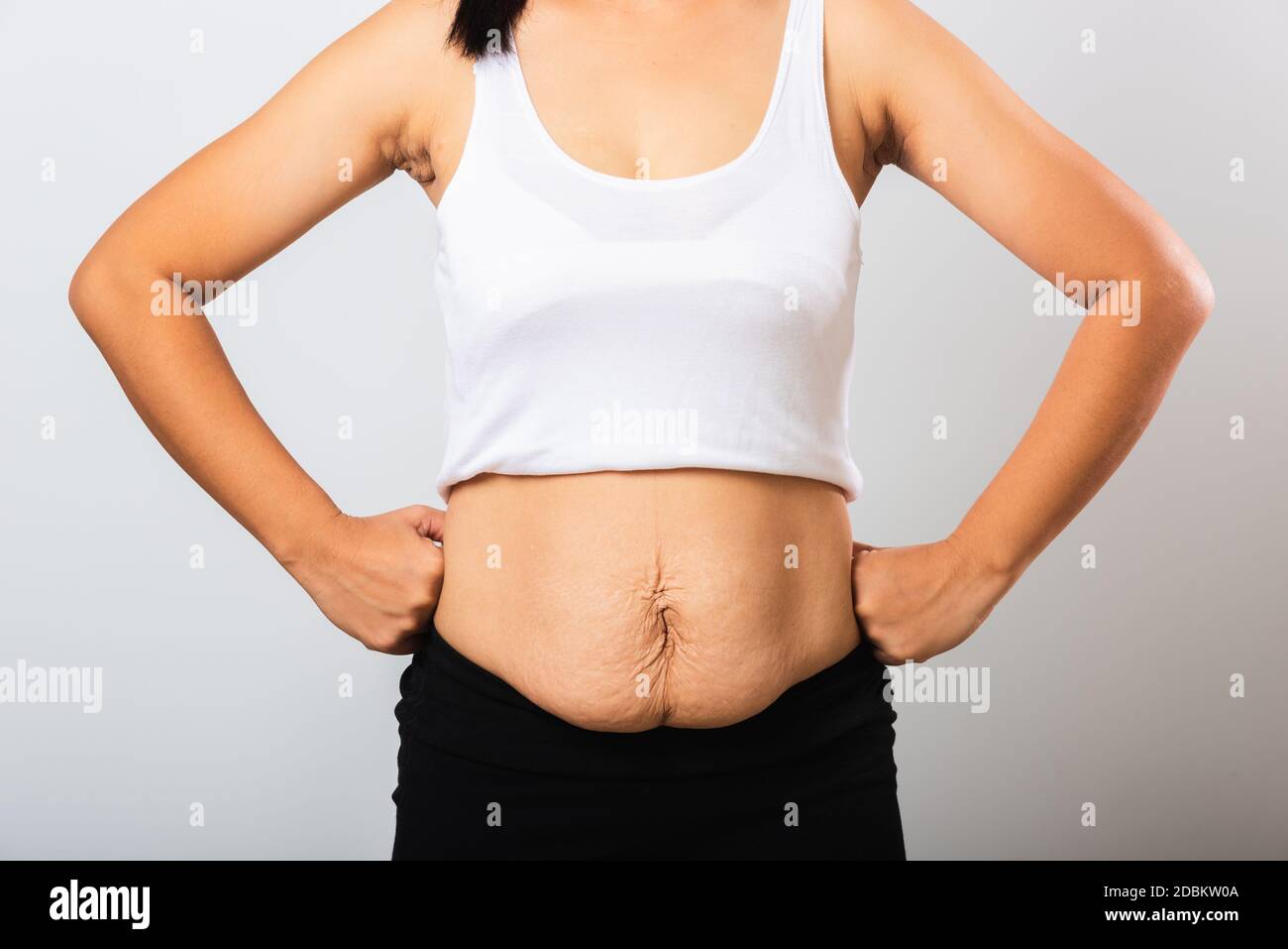 Close up of Asian mother woman showing stretch mark loose lower abdomen skin she fat after pregnancy baby birth, studio isolated on white background, Stock Photo