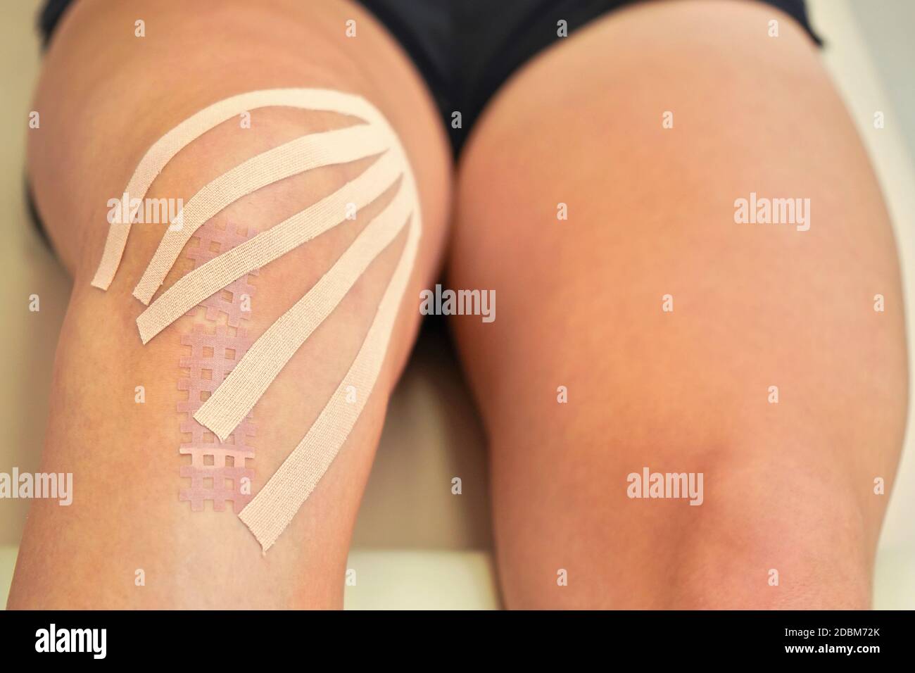 Kinesiology tape in body color cut to thin stripes applied to knee of female patient, closeup detail. Stock Photo