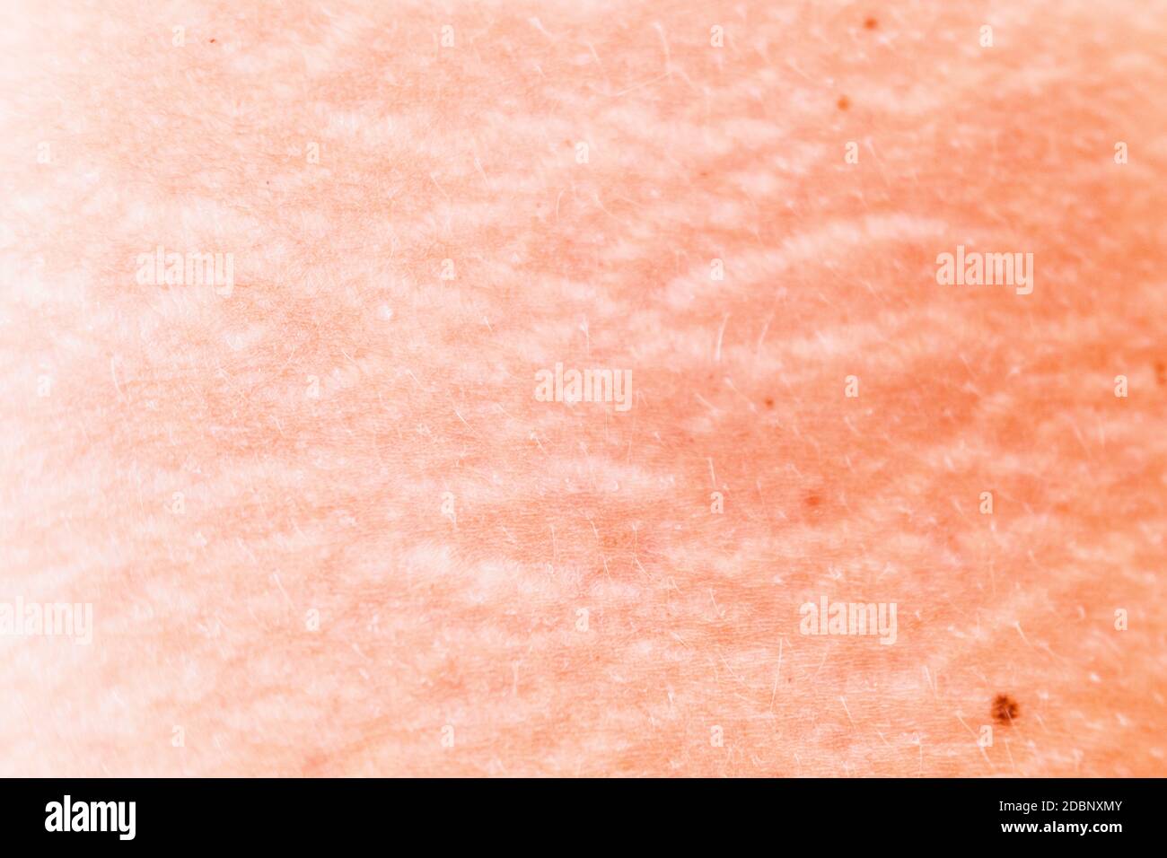 Stretch marks on the skin of a middle-aged woman, detail. Stock Photo