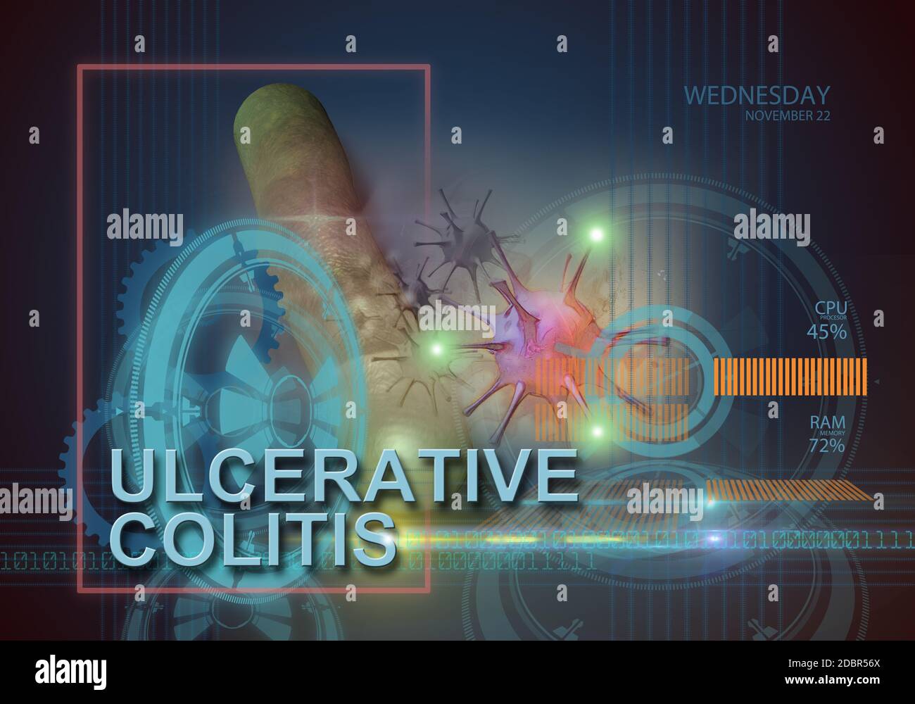 hi tech infographics of ulcerative colitis made in 3d software Stock Photo