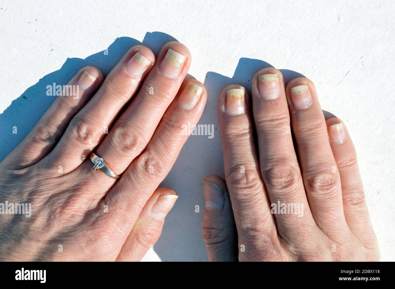 Fungal nail infection, onycholysis after shellac or gel-varnish on white background Stock Photo