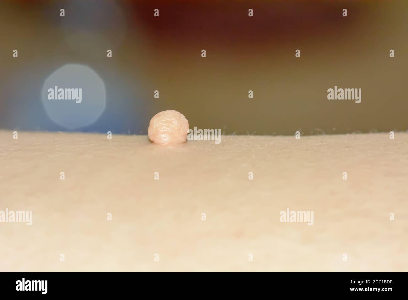 Skin tag or acrochondon or soft fibroma is a safe. It have not effect