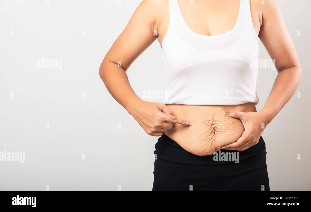 Close up of Asian mother woman pointing stretch mark loose lower abdomen skin she fat after pregnancy baby birth, studio isolated on white background, Stock Photo