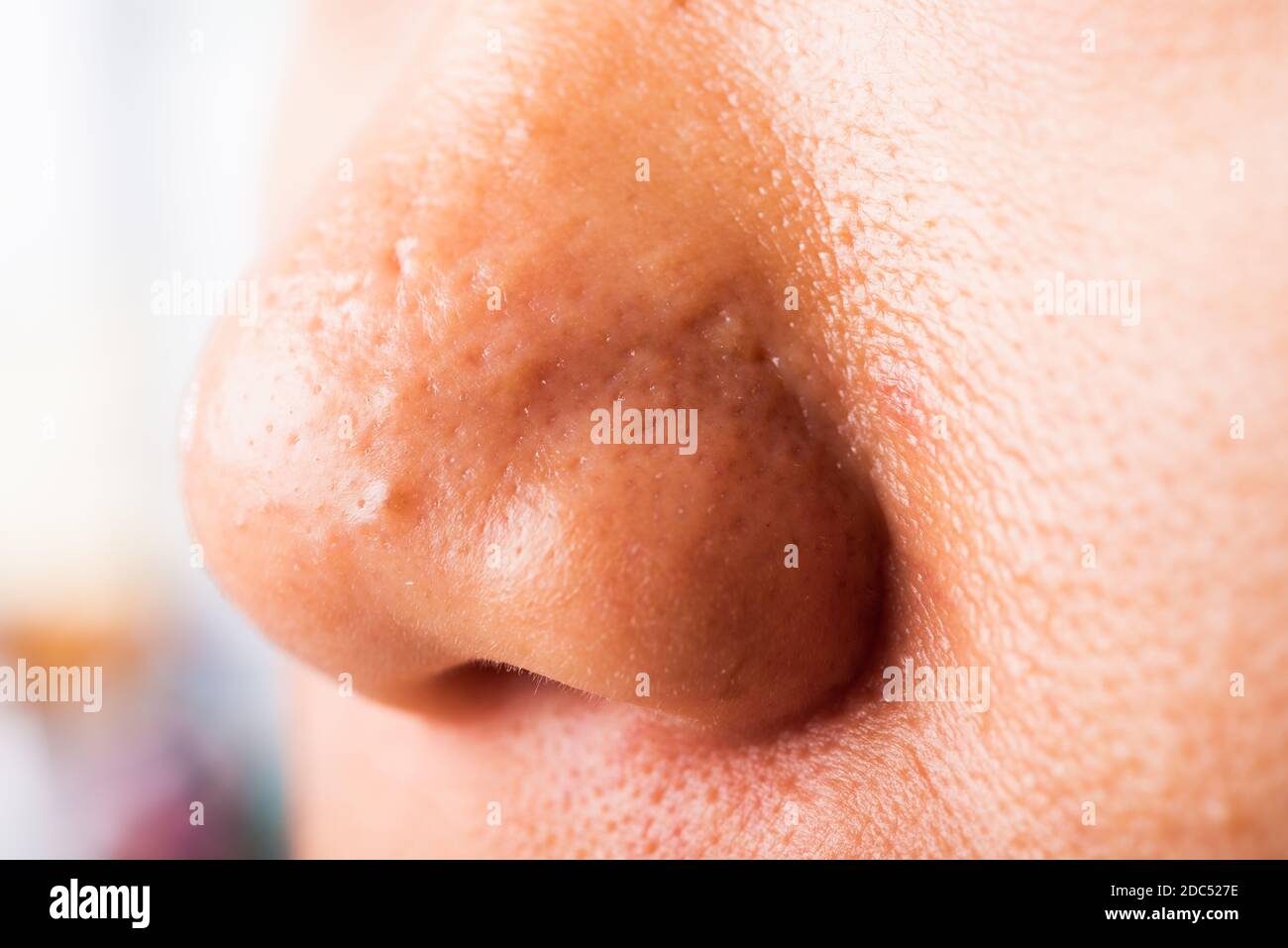 Closeup Asian young woman large pores have freckles cheek oily, acne pimple  on nose, studio shot isolated on white background, Healthcare beauty skin  Stock Photo - Alamy