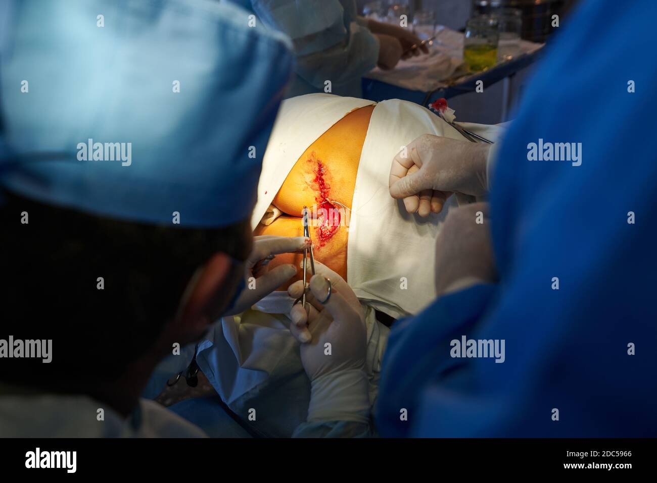 Surgery A Surgeon Sutures The Skin Medical Intervention Stock Photo 