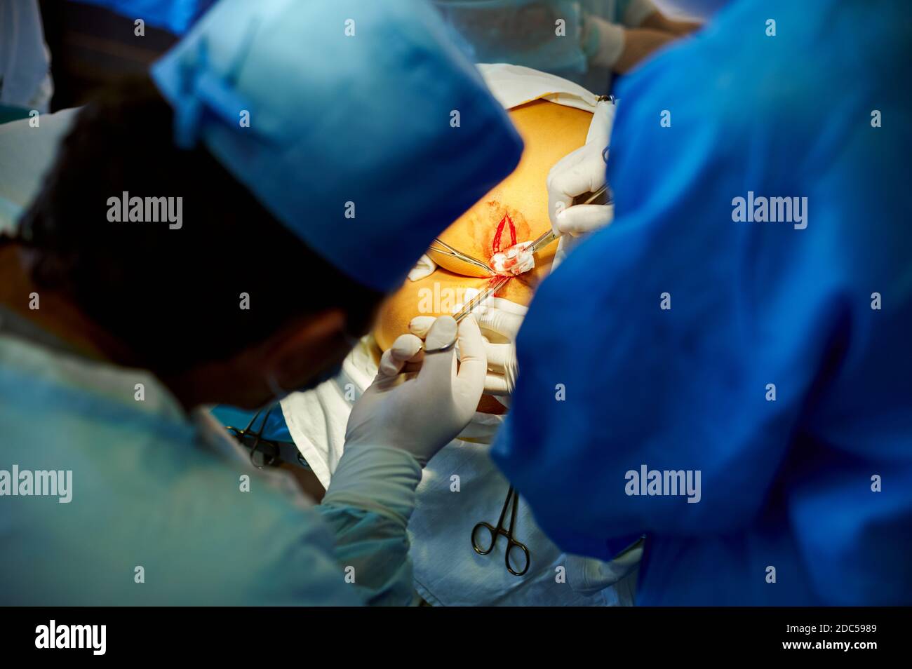 Scar Tissue High Resolution Stock Photography and Images Alamy