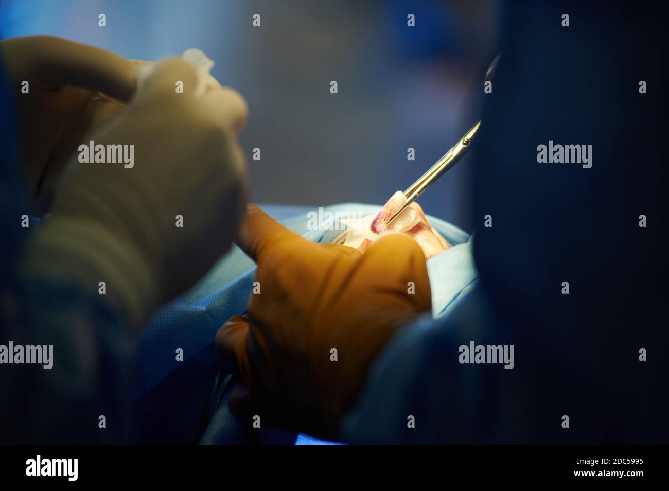 Surgery. Closeup of surgeon's hand with a clamp. Bleeding Stock Photo