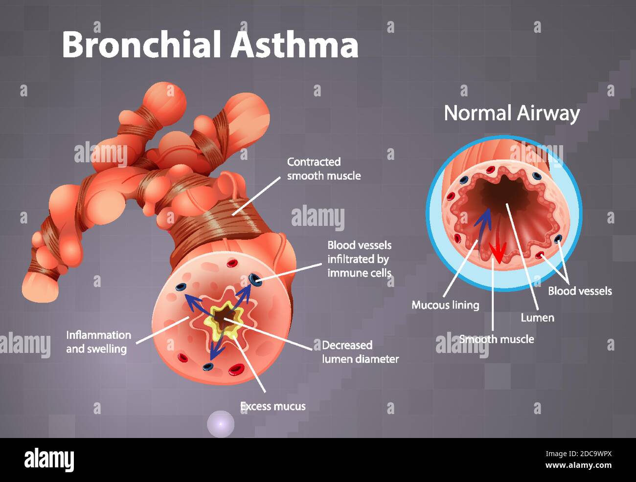Asthma inflamed bronchial tube illustration Stock Vector Image & Art