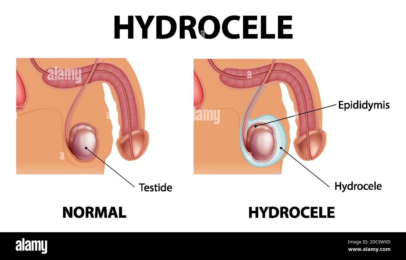 Medical poster showing different between male normal testicle and hydrocele illustration Stock Vector