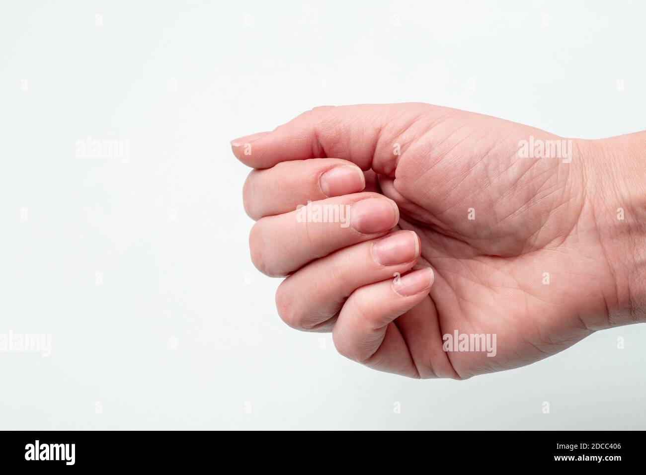 Pitted nails due to severe atopic dermatitis - Stock Image - C056/1057 -  Science Photo Library