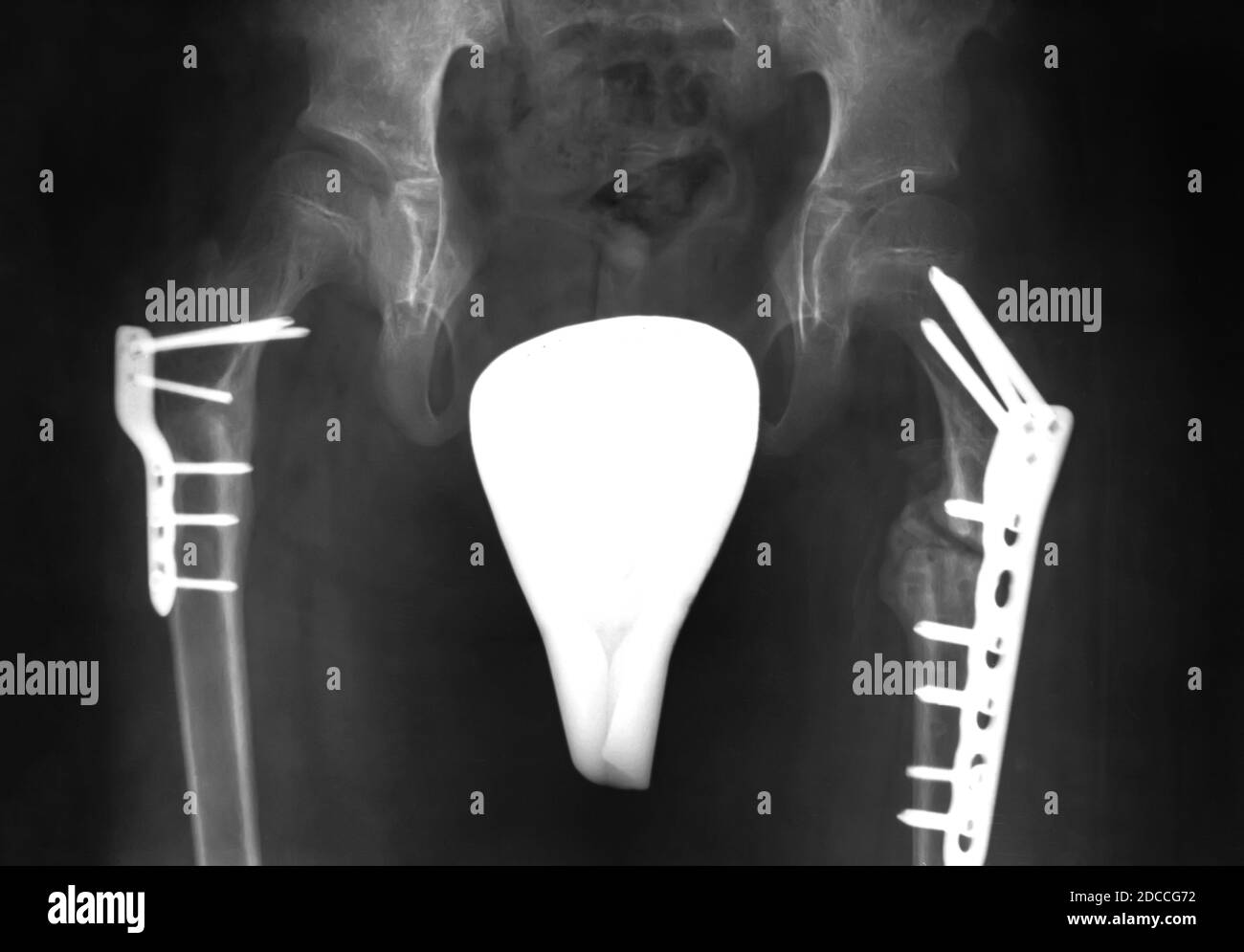 xray film broken bone at hip install plate with screw Stock Photo Alamy