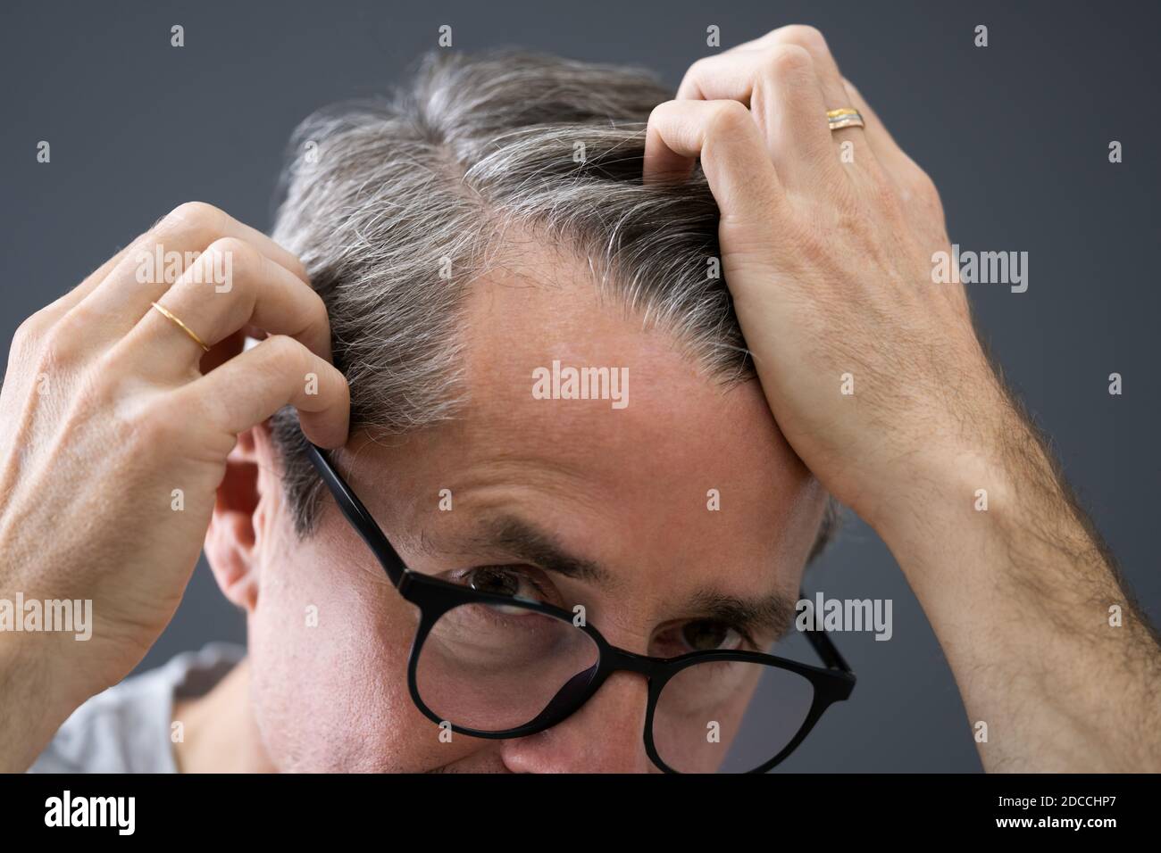 Balding Man Losing Hair. Checking Scalp Hair Loss Stock Photo