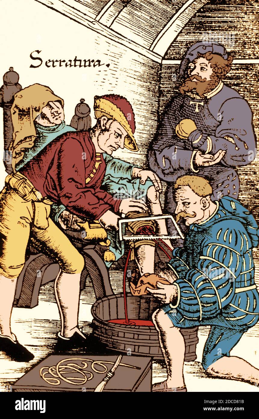 Amputation, 16th Century Stock Photo