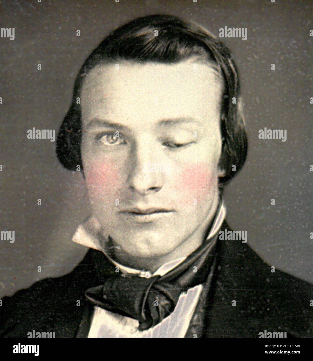 Ptosis, Daguerreotype, 1852 Stock Photo