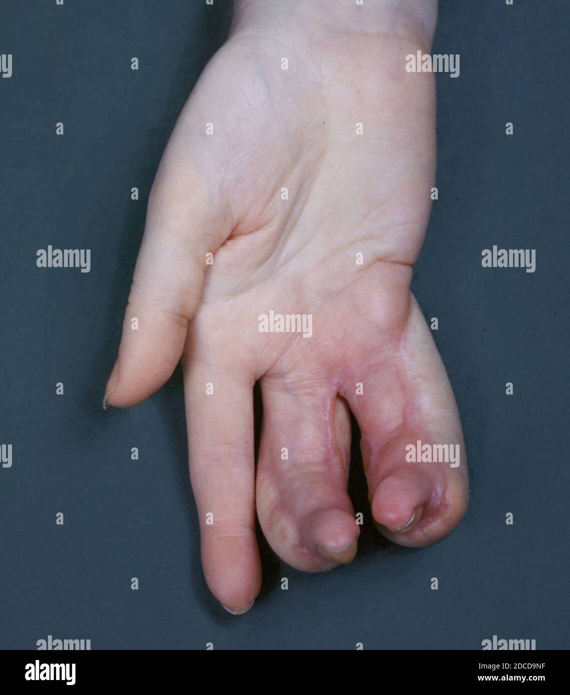 https://c8.alamy.com/comp/2DCD9NF/deformity-from-x-ray-burns-2DCD9NF.jpg