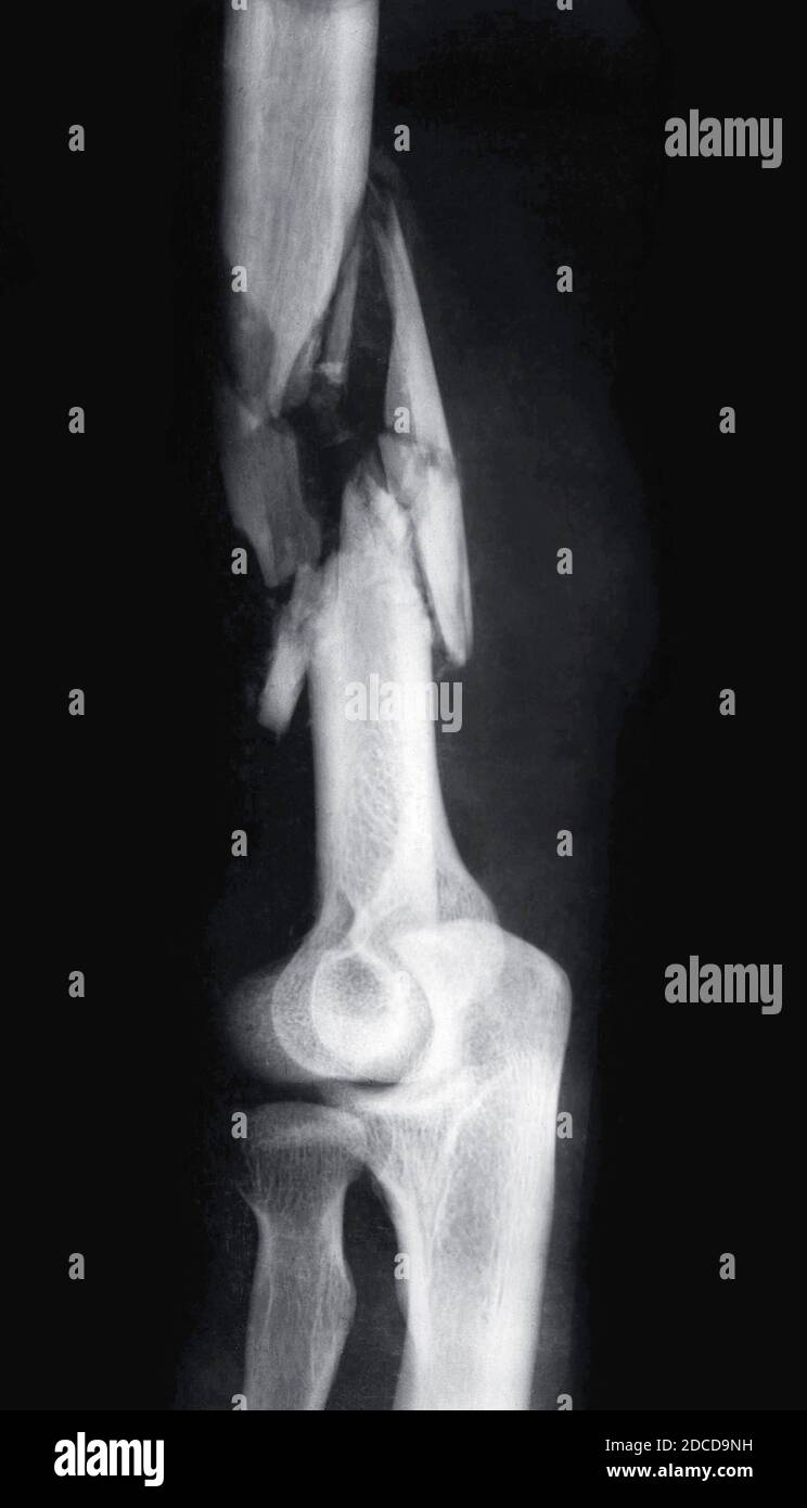 Bone Fracture, X-Ray, First World War Stock Photo
