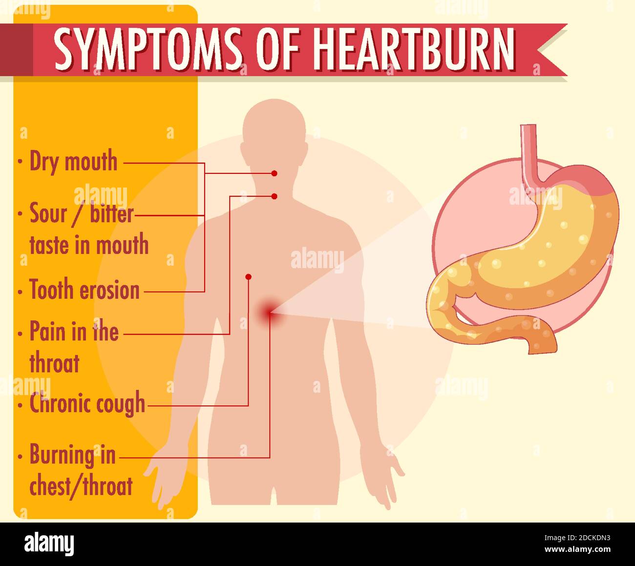 Symptoms of heartburn information infographic illustration Stock Vector Image & Art Alamy