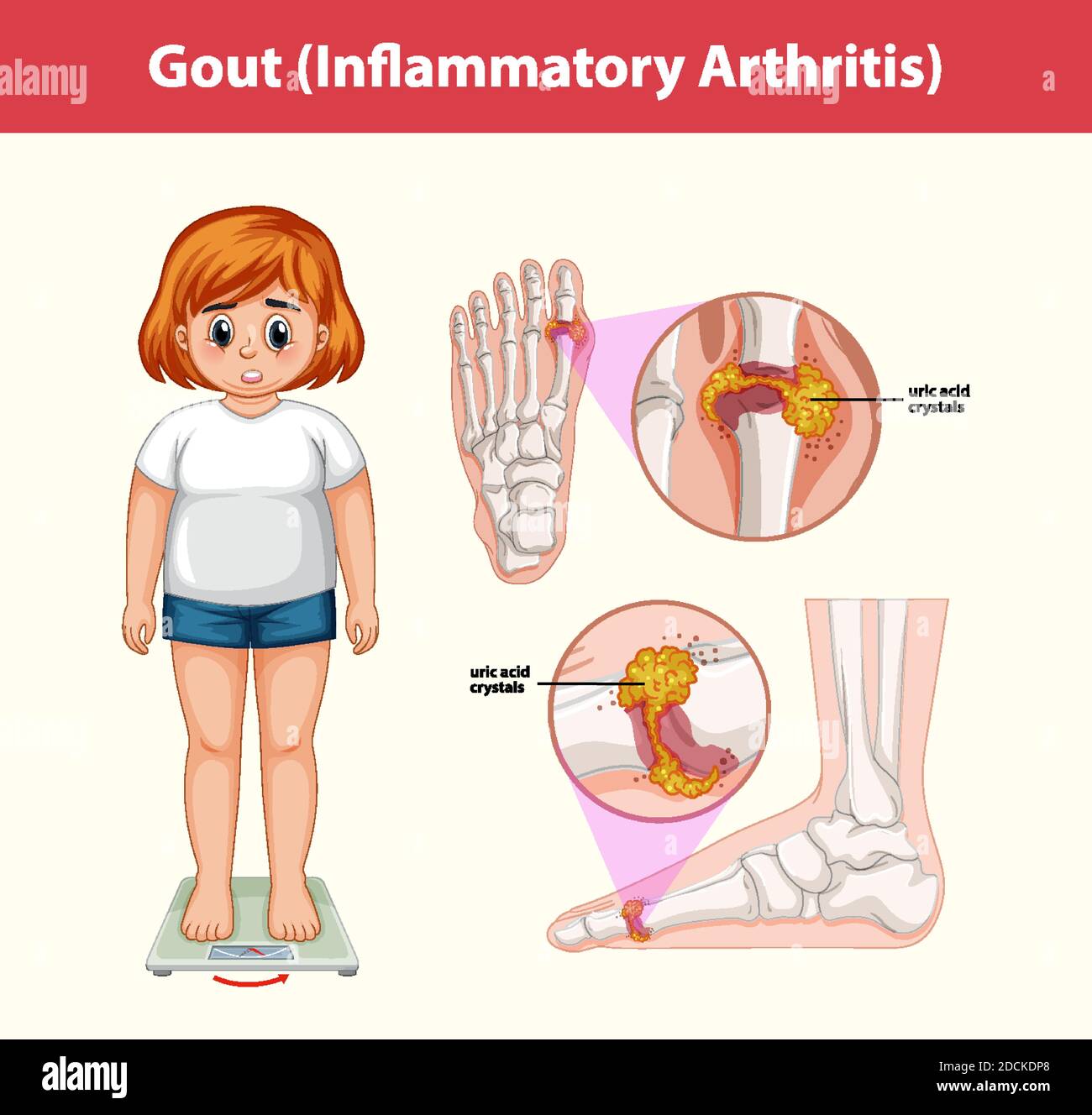 Gout (Inflammatory Arthritis) medical information illustration Stock