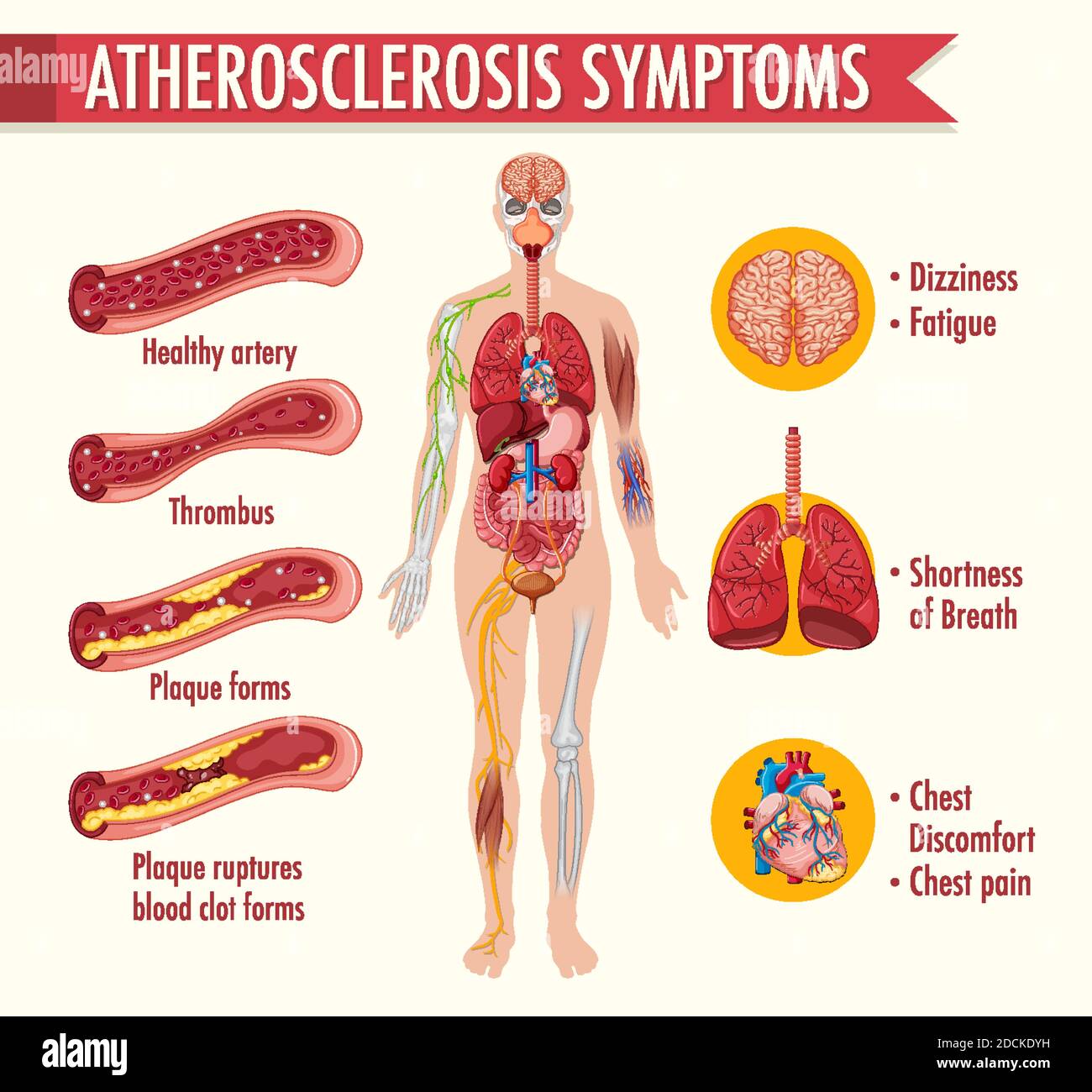 Stages of atherosclerosis information infographic illustration Stock ...