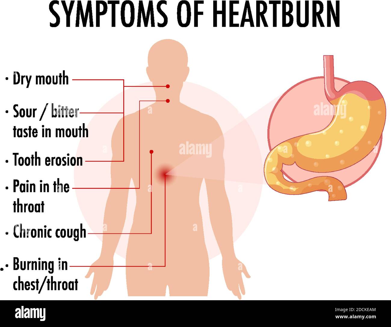 Symptoms of heartburn information infographic illustration Stock Vector