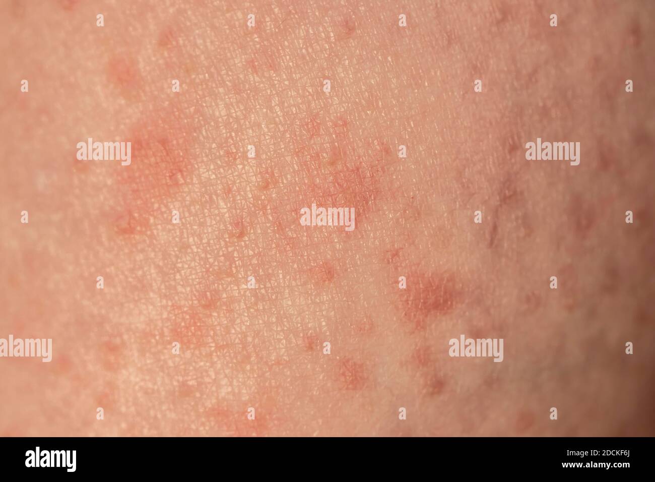 Skin with reddened spots, rash, allergy Stock Photo