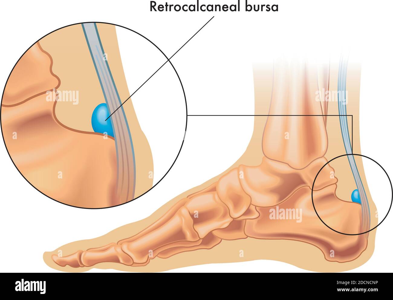 Illustration showing the position of the retrocalcaneal bursa in the foot, with an enlarged detail, and annotation. Stock Vector