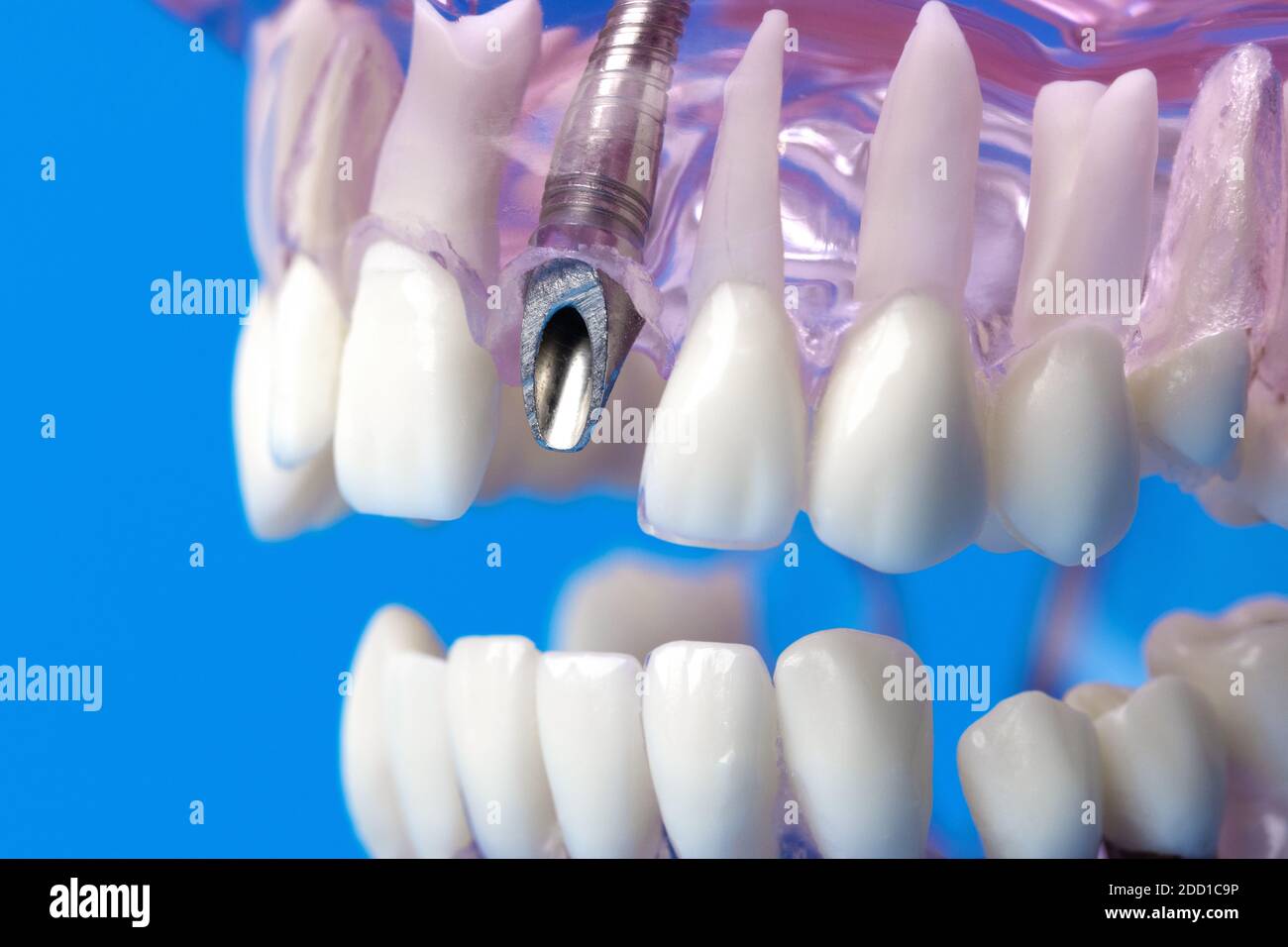 dental implant screw in human jaw teeth model Stock Photo