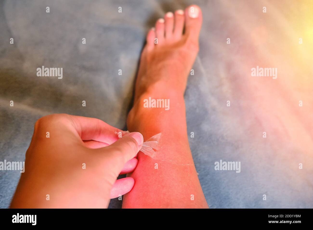 Burnt red skin on the legs after sunburn, real photo Stock Photo