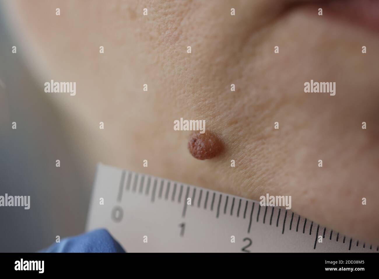 Ruler Rash Size Doctor measuring size of patients pigmented nevus with ruler in clinic ...